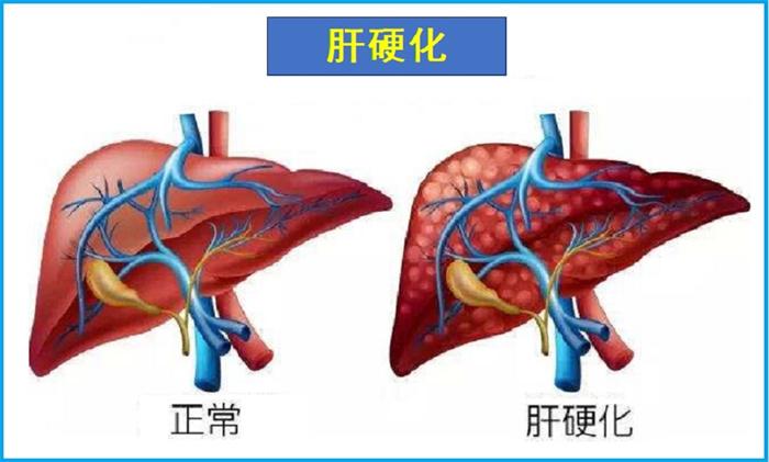 肝硬化如何饮食（应该怎么做）